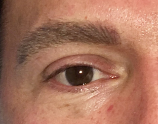 Men's eyebrow after the procedure gives more defined and youthful looking brows.